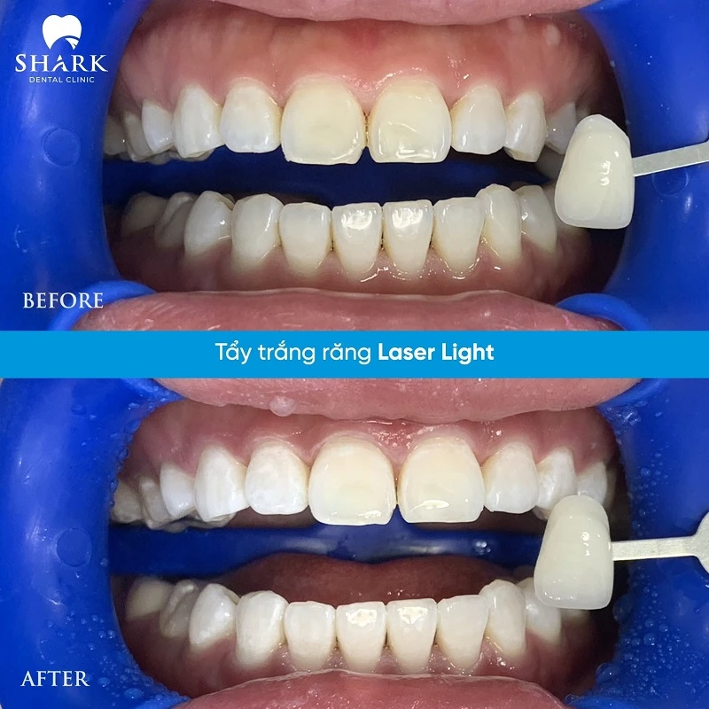 Tẩy trắng răng ở Nha khoa Shark uy tín và chất lượng