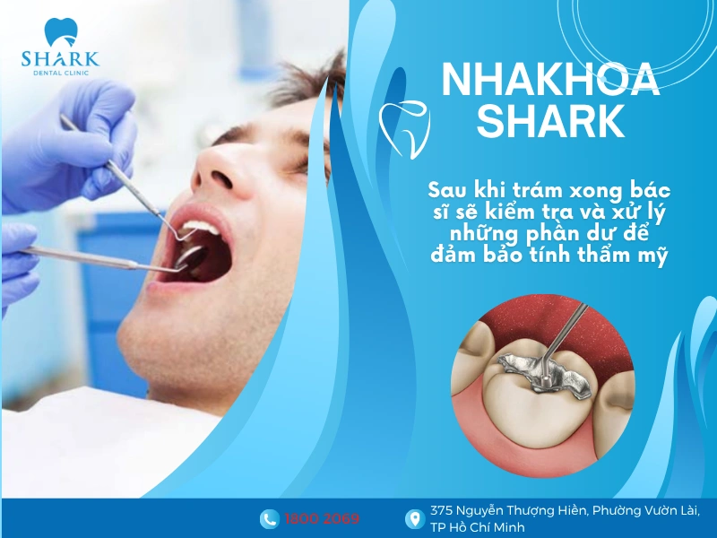 Sau khi trám xong, bác sĩ sẽ kiểm tra lại răng và xử lý những phần dư để đảm bảo tính thẩm mỹ