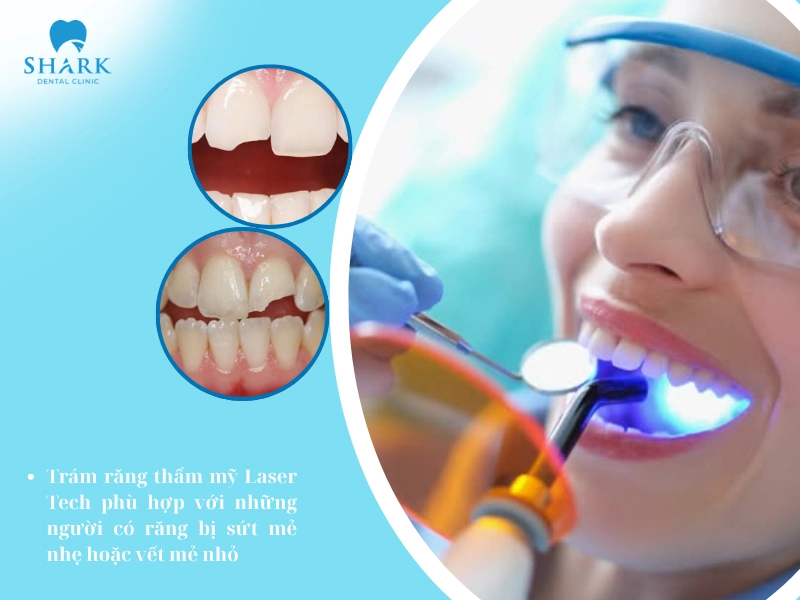 Phù hợp với người có răng bị sứt mẻ nhẹ hoặc có vết mẻ nhỏ