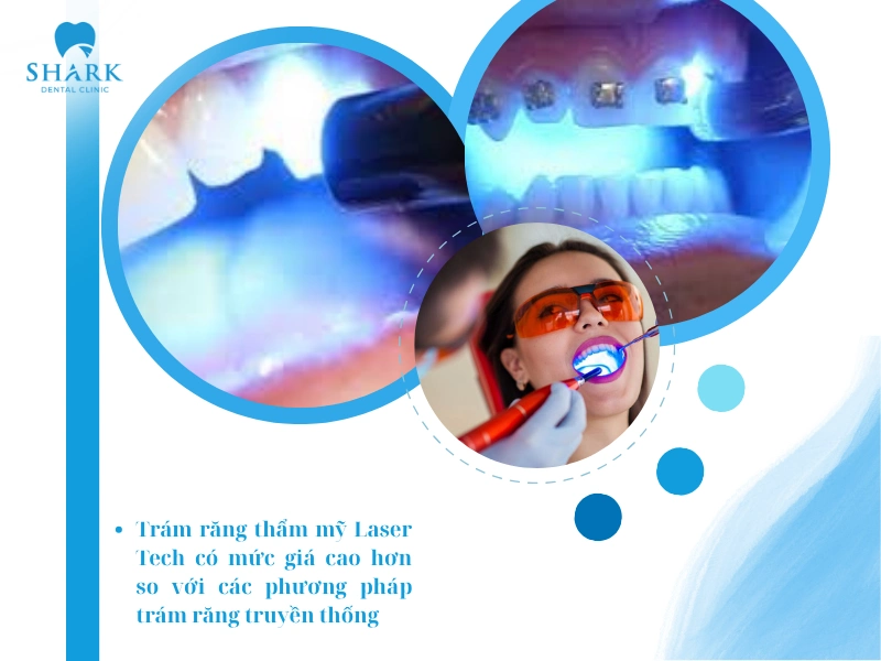Chi phí trám răng Laser Tech có mức giá cao hơn so với các phương pháp truyền thống