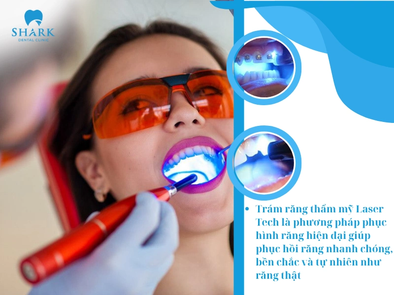 Trám răng thẩm mỹ Laser Tech là phương pháp phục hình răng hiện đại
