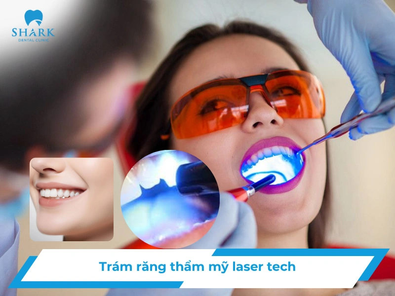 trám răng thẩm mỹ laser tech