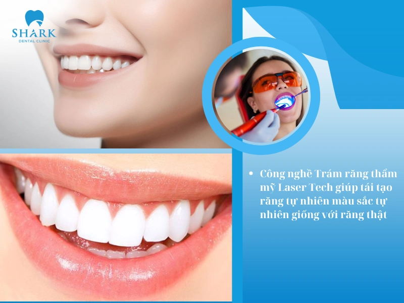 Công nghệ này giúp tái tạo hình thể răng một cách tự nhiên, màu sắc hài hòa với răng thật