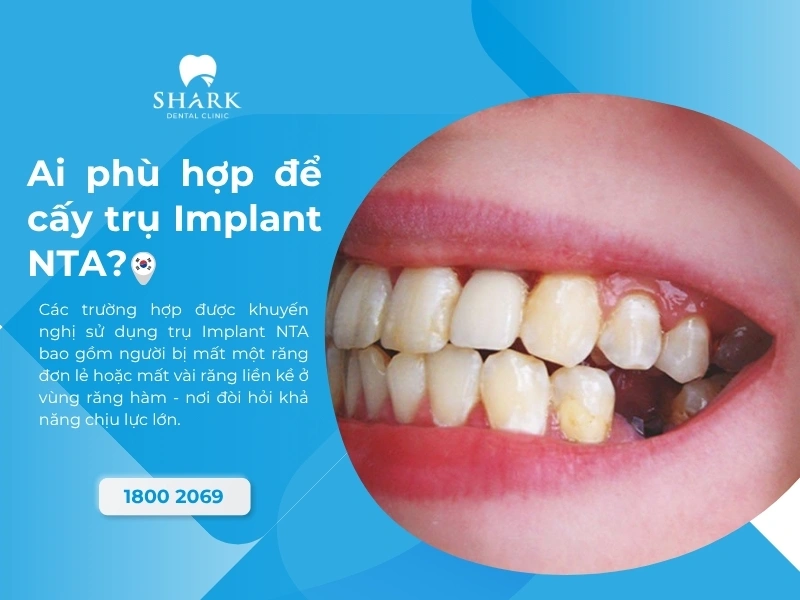 Đối tượng phù hợp với trụ Implant NTA