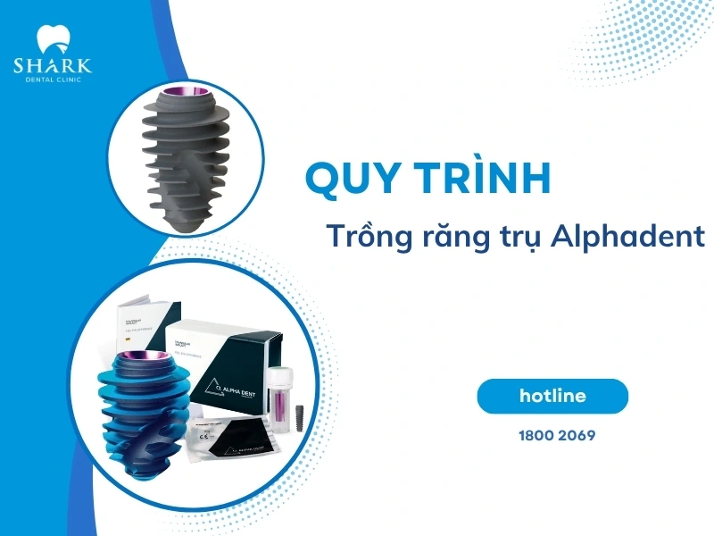 Quy trình cấy ghép trụ Implant cần thực hiện ở môi trường vô khuẩn