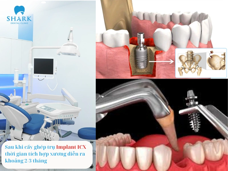 Thời gian tích hợp xương thường diễn ra trong khoảng 2-3 tháng