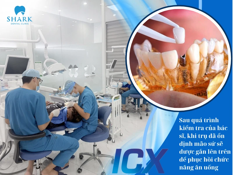 Khi trụ đã ổn định, mão sứ sẽ được gắn lên trên nhằm khôi phục tối đa chức năng ăn nhai