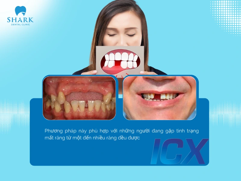 Phù hợp với người mất một hoặc nhiều răng do bệnh lý, tai nạn hay quá trình lão hóa