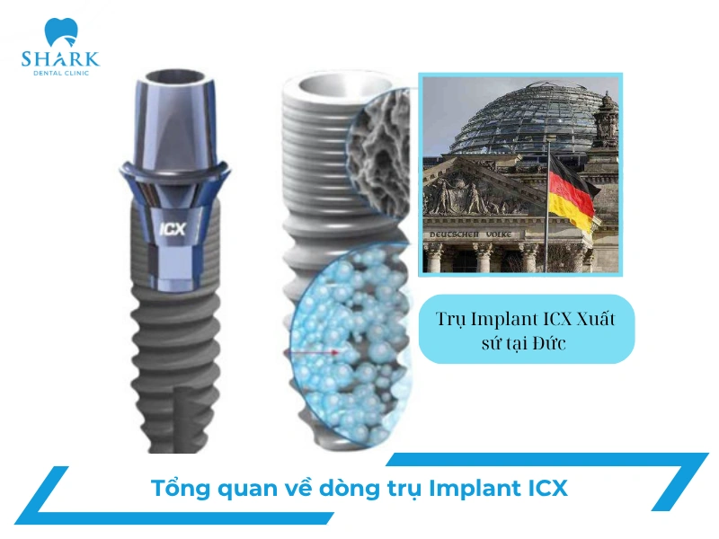 trụ Implant ICX có tốt không
