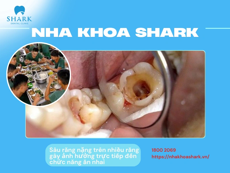 Sâu răng nặng với nhiều răng gây ảnh hưởng trực tiếp đến chức năng ăn nhai nên có thể được cân nhắc