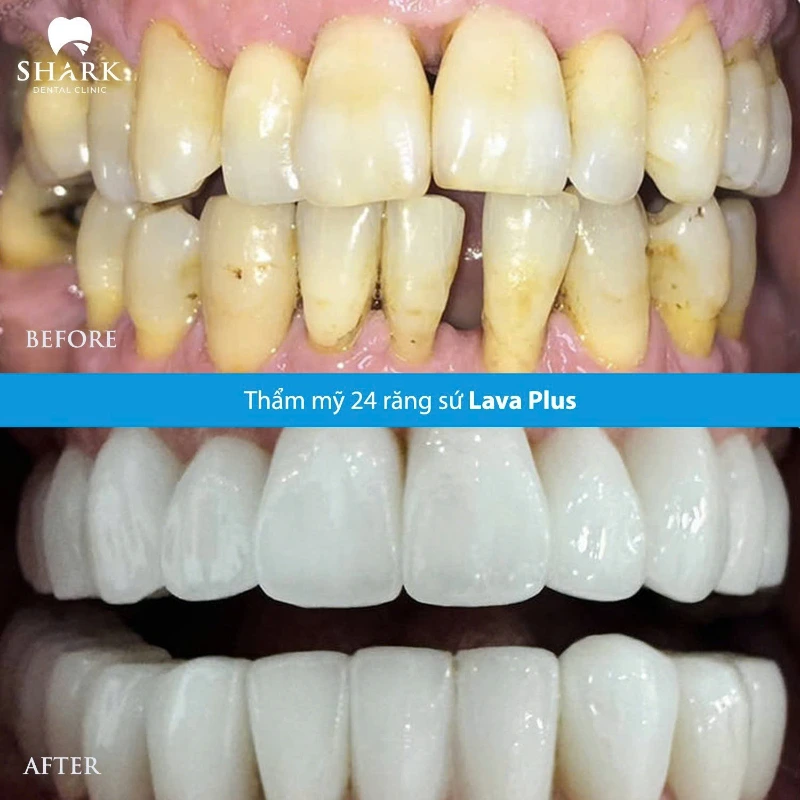 Trước và sau khi bọc sứ Lava Plus của chị Hà