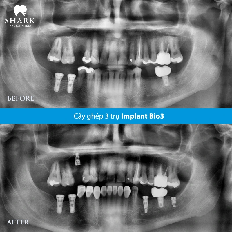 Trồng 3 trụ răng Bio3 cho chị Huyền
