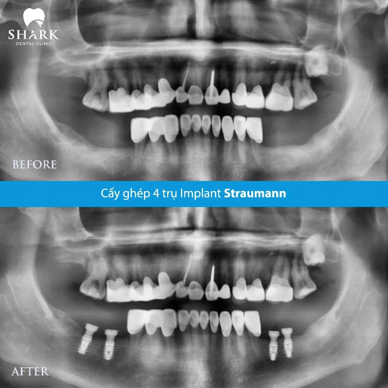Đánh giá trụ Implant Thụy Sĩ: Phân loại và bảng giá chi tiết 9 X-quang trước và sau khi trồng Implant Straumann của chú Nam