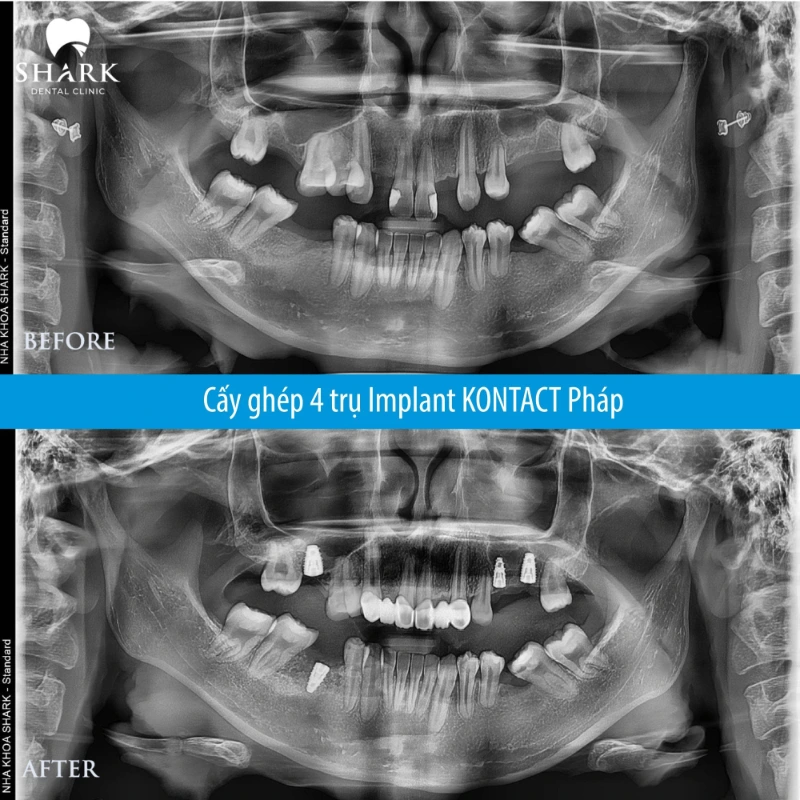 Trụ Implant Kontact có xuất xứ ở đâu? Giá bao nhiêu tiền? 7 X-quang của chú Thạch cấy 4 trụ Kontact