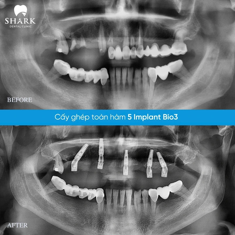 Trồng răng implant cho người già được không? Cần lưu ý gì? 15 X-quang Implant all on 5 hàm trên cho cô Phạm Hương