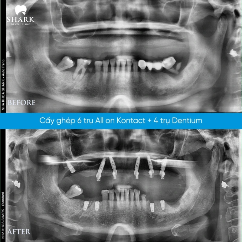 Trồng răng Implant mất bao lâu? Tổng thời gian cấy cho 1 người 11 X-quang trước và sau khi cấy 6 trụ Kontact hàm trên và 4 trụ Dentium hàm dưới của anh Hoàng Nam