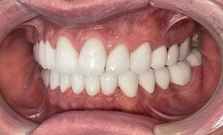 Kết quả sau khi bọc sứ Zirconia