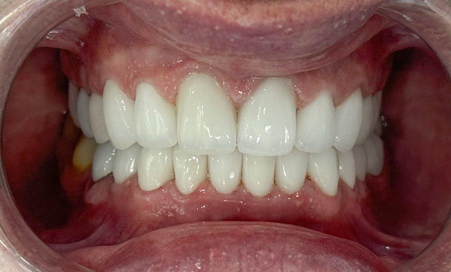 Kết quả sau khi bọc sứ Zirconia