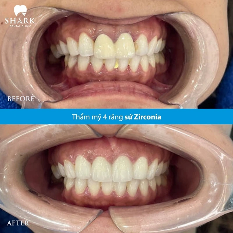 Bọc răng sứ 1 chiếc được không? Giá bao nhiêu tiền? 9 Bọc 4 răng sứ Zirconia