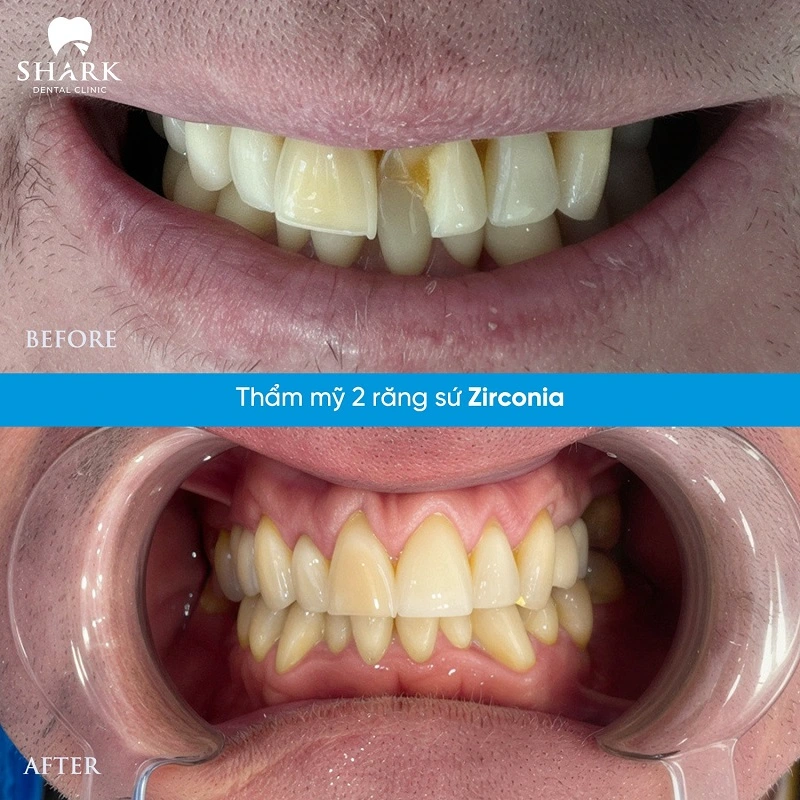 Bọc răng sứ 1 chiếc được không? Giá bao nhiêu tiền? 10 Thẩm mỹ 2 răng sứ Zirconia