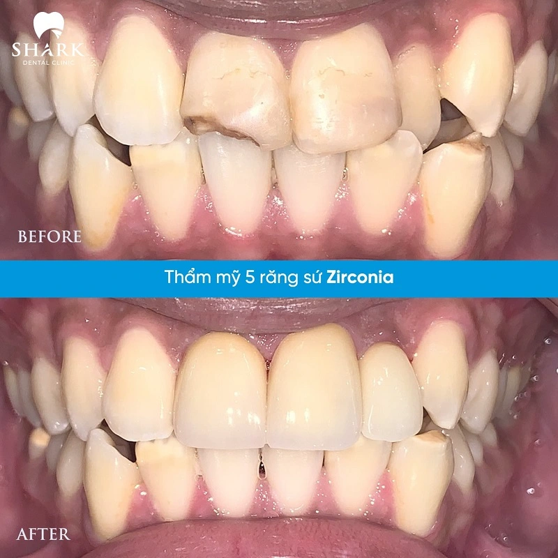 Bọc răng sứ 1 chiếc được không? Giá bao nhiêu tiền? 11 Khách hàng làm 5 chiếc răng sứ Zirconia