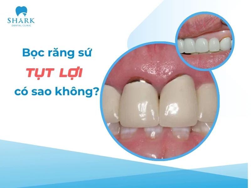 Bọc răng sứ bị tụt lợi