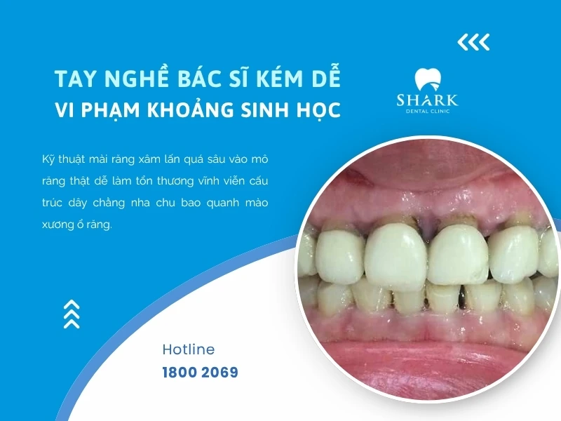 Bác sĩ tay nghề kém dễ bị vi phạm khoảng sinh học khi mài răng bọc sứ