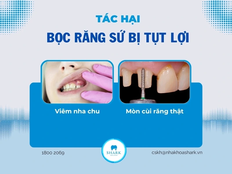 Tác hại khi không điều trị tụt lợi sớm khi bọc sứ
