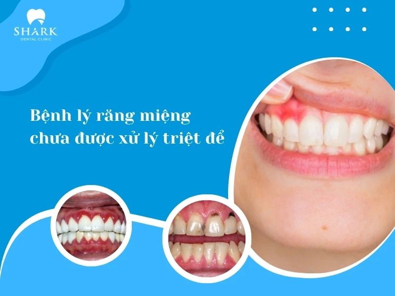 Răng miệng còn các bệnh lý chưa xử lý thì dễ bị tụt lợi về sau