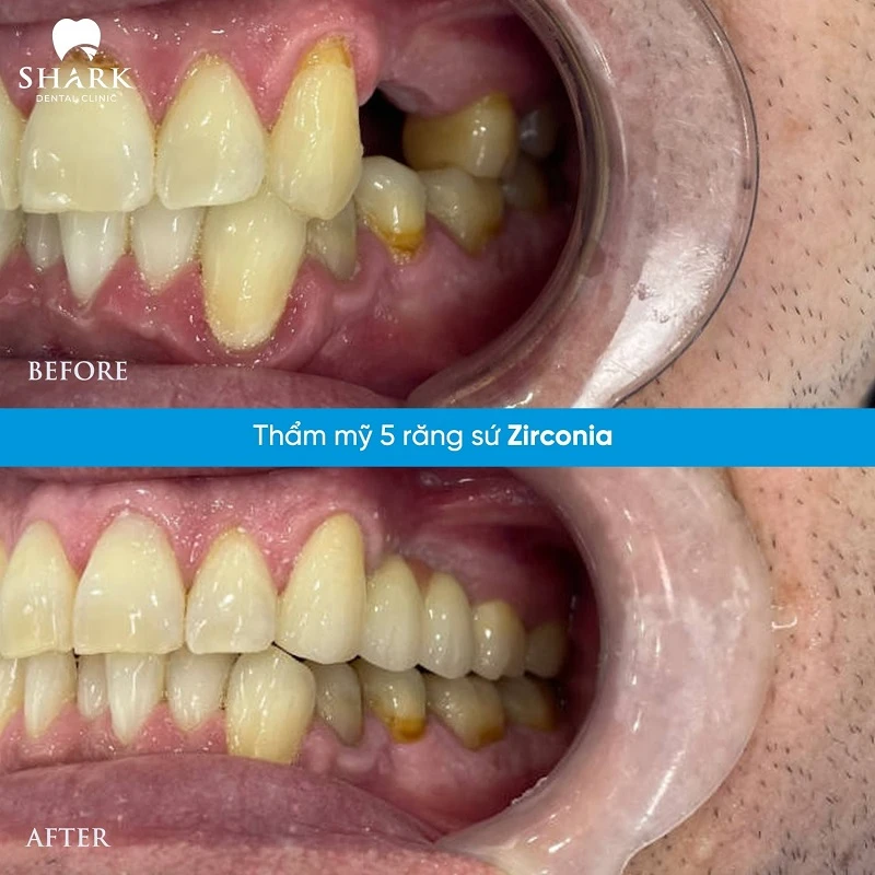 Bọc sứ răng hàm Zirconia tại Nha khoa Shark