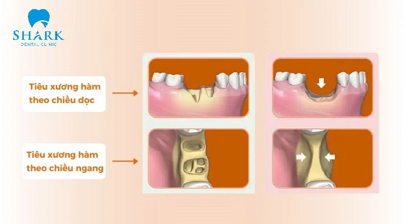Mất răng bao lâu thì bị tiêu xương hàm? Giải pháp khắc phục 14 Các dạng tiêu xương hàm hiện nay