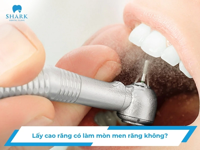 Lấy cao răng có làm mòn men răng không