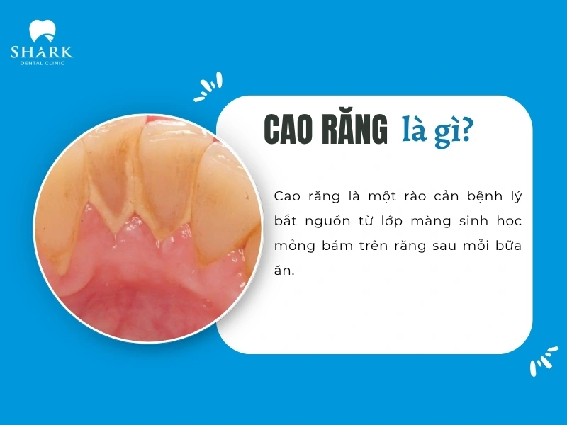 Bác sĩ giải đáp: Lấy cao răng có làm mòn men răng không? 11 Cao răng là mảng báo do thức ăn để lại