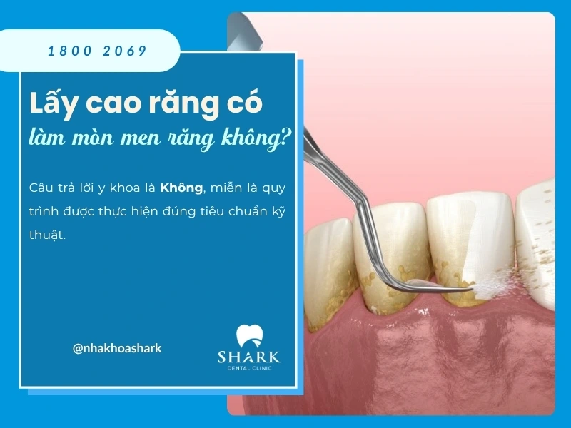 Bác sĩ giải đáp: Lấy cao răng có làm mòn men răng không? 12 Lấy cao răng không làm mòn men răng