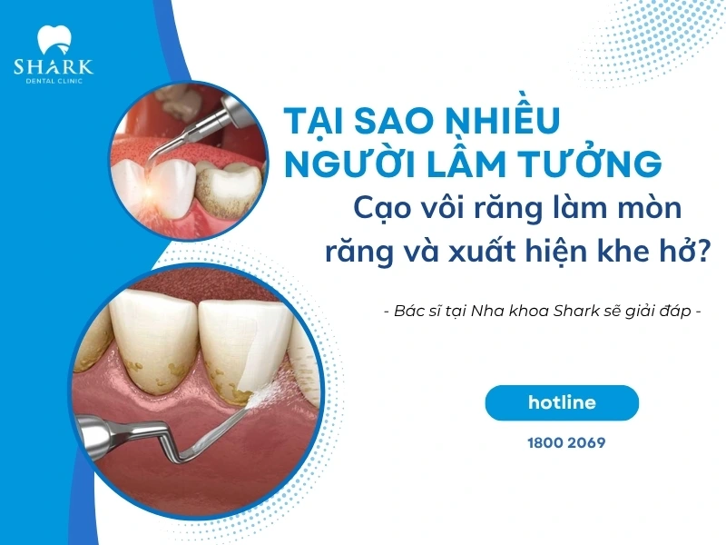 Bác sĩ giải đáp: Lấy cao răng có làm mòn men răng không? 13 Lầm tưởng khi lấy cao răng lại xuất hiện khe hở được bác sĩ Nha khoa Shark giải đáp rõ ràng