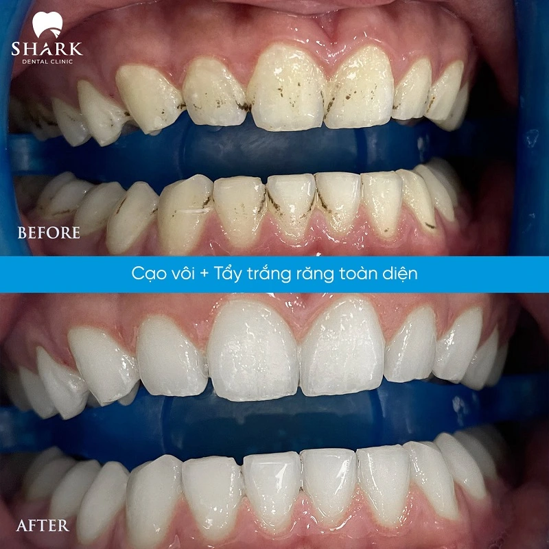 Bác sĩ giải đáp: Lấy cao răng có làm mòn men răng không? 16 Hình ảnh thực tế của khách hàng khi sử dụng dịch vụ lấy cao răng chuyên nghiệp ở Shark