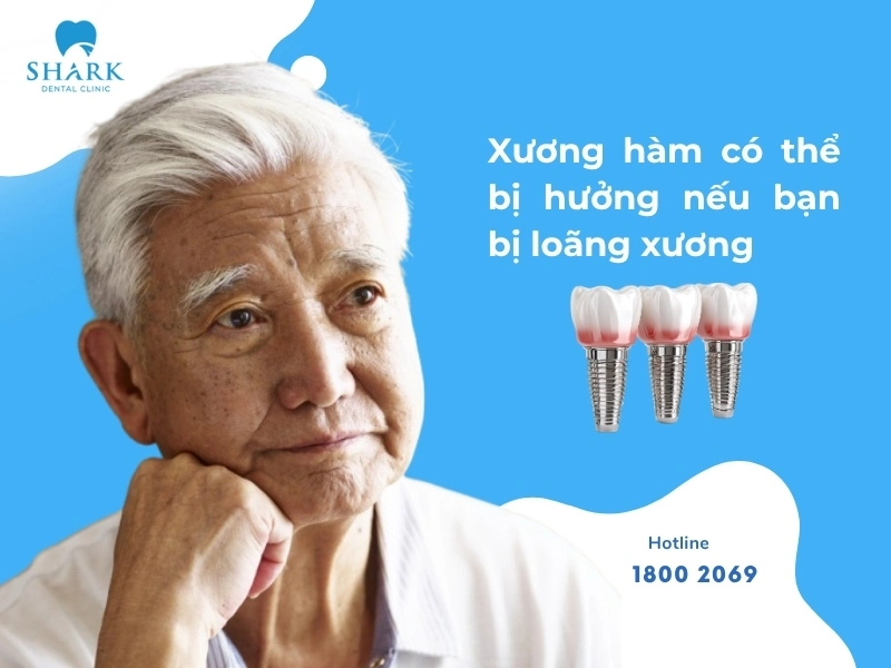 Bệnh loãng xương cũng có thể gây ảnh hưởng đến xương hàm như tiêu xương hàm,...