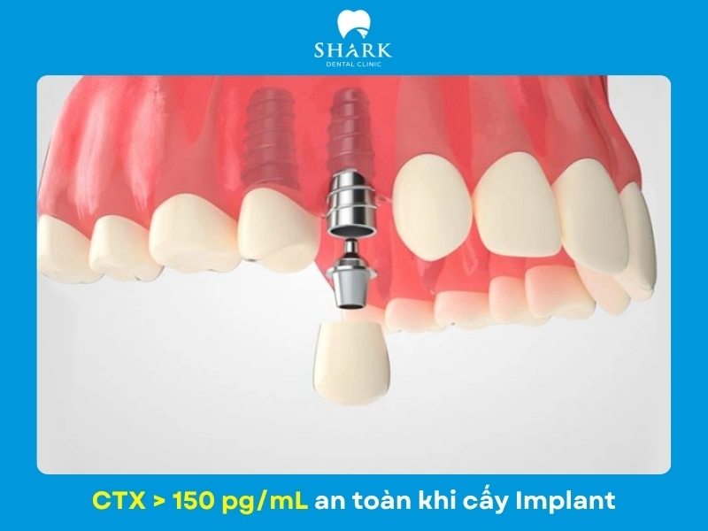 Chỉ số CTX > 150 pg/mL đây được xem là ngưỡng chỉ số an toàn để thực hiện cấy ghép Implant