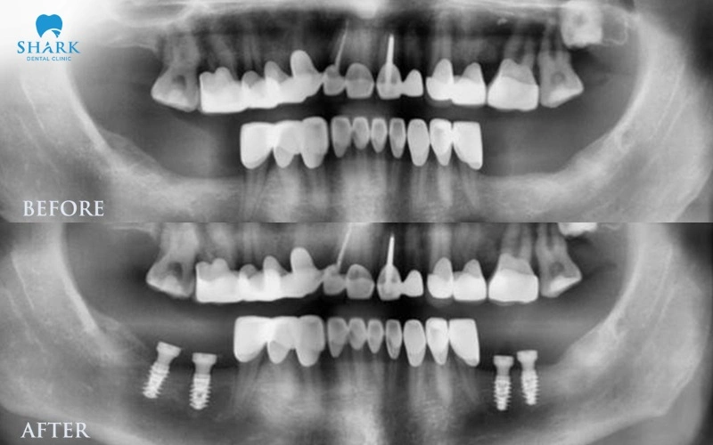 Hình ảnh X-quang của bệnh nhân nam thực hiện cấy ghép Implant có tiền sử bệnh loãng xương 10 năm