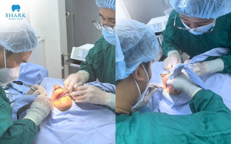 Nha khoa Shark - địa chỉ cấy ghép Implant an toàn cho người bị loãng xương