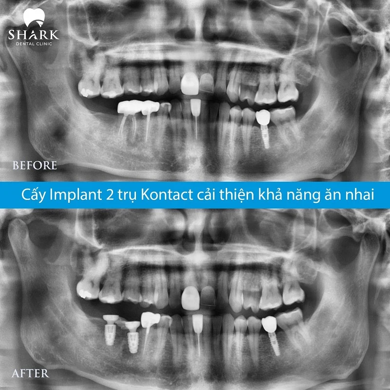 X-quang của khách trồng răng trụ Pháp