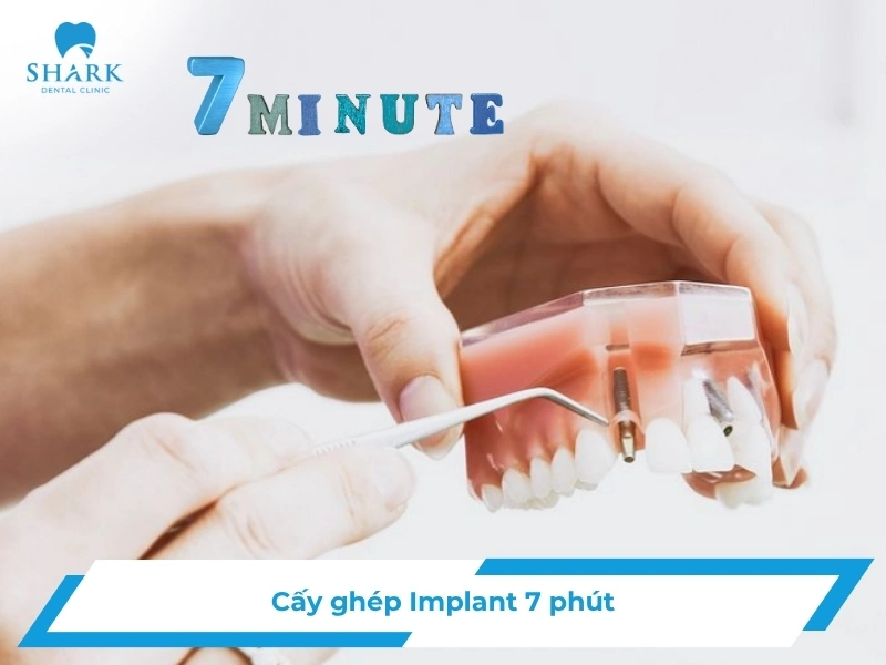Cấy ghép Implant 7 phút