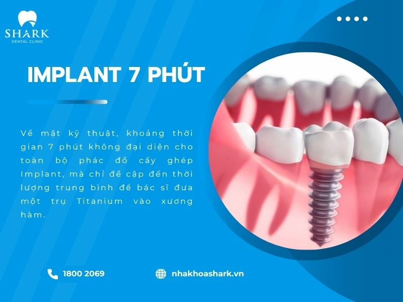 Cấy ghép Implant trong 7 phút