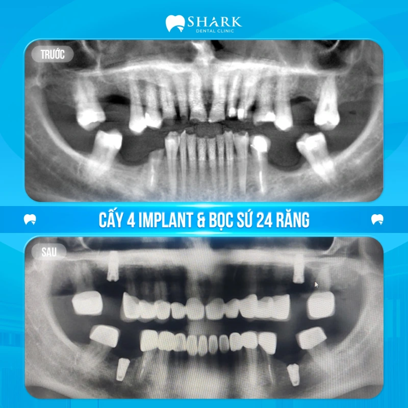 Mất răng bao lâu thì bị tiêu xương hàm? Giải pháp khắc phục 18 X-quang răng của anh Tuấn Anh sau khi cấy 4 trụ Implant tại nha khoa Shark