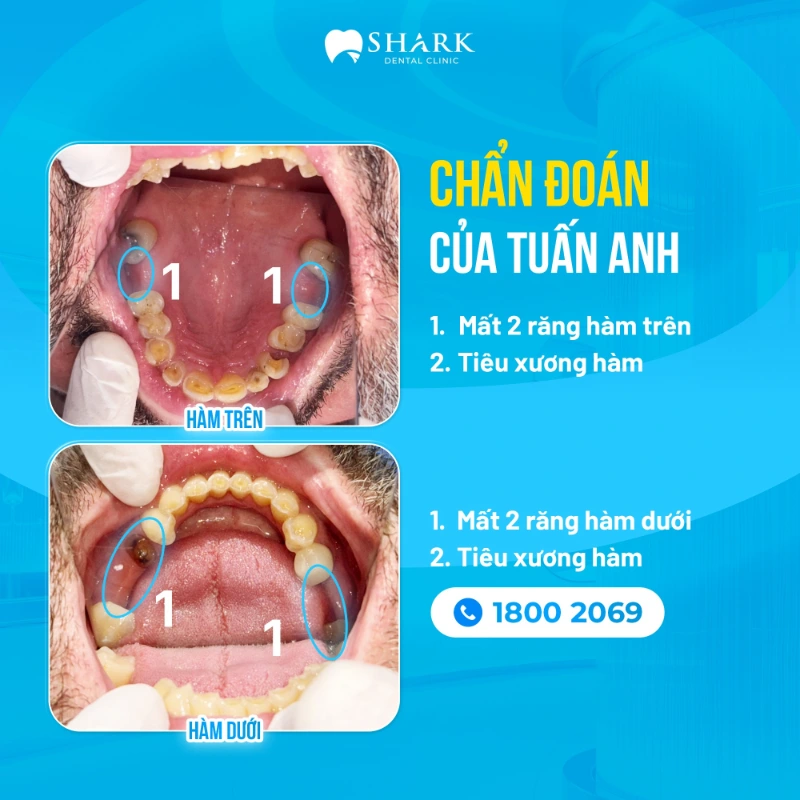 Mất răng bao lâu thì bị tiêu xương hàm? Giải pháp khắc phục 17 Chẩn đoán tiêu xương hàm của anh Tuấn Anh