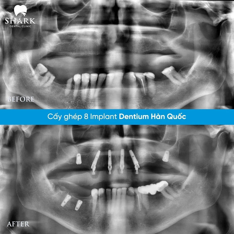 Nguyên nhân răng Implant bị lung lay là gì? Cách khắc phục 15 X-quang chị Hoài Tâm sau khi cấy ghép 8 trụ răng Dentium thành công