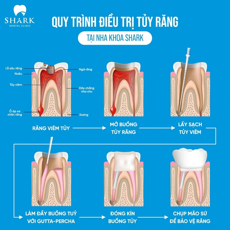 Quy trình lấy chỉ máu răng chuẩn y khoa tại Shark