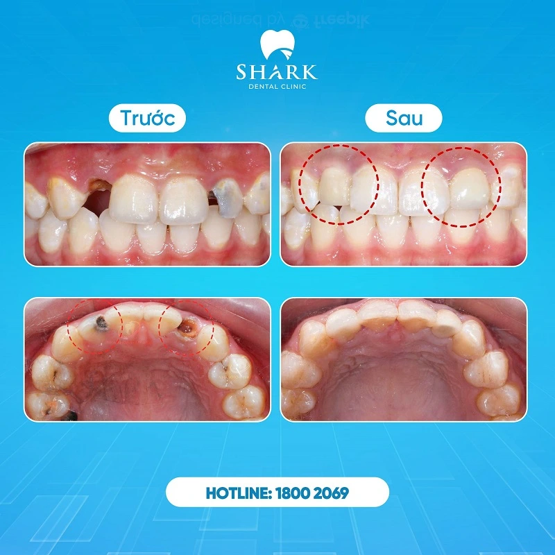 Trước và sau khi điều trị tủy răng ở Shark