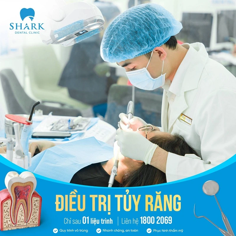 Điều trị viêm tủy răng tại Nha khoa Shark