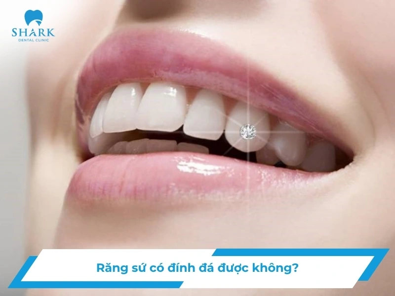 Răng sứ đính đá
